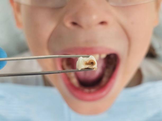 Best Emergency Tooth Extraction in West Point, VA